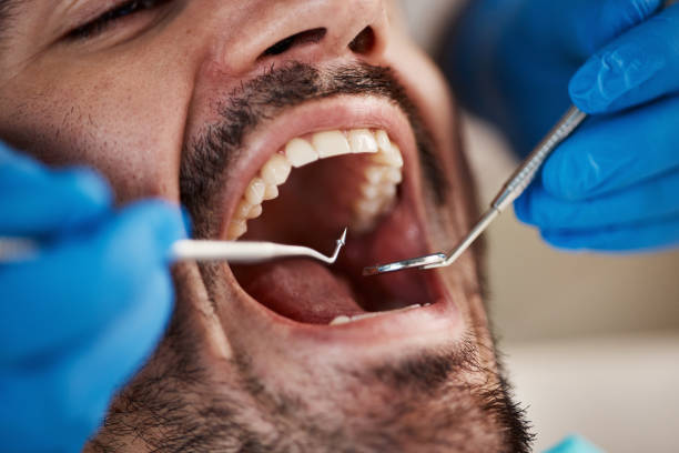 Best Emergency Dental Extractions in Livingston, TN