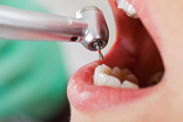 Best Emergency Dental Extractions in Livingston, TN